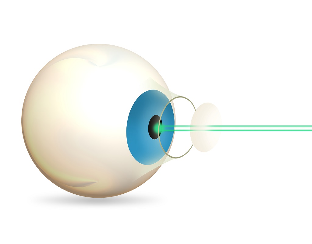 RLE (Refractive Lens Exchange) vs. LASIK What's the Difference